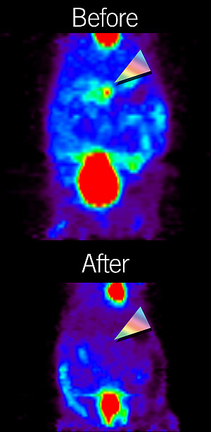 A Lkb1+/- mouse before and after treatment with rapamycin