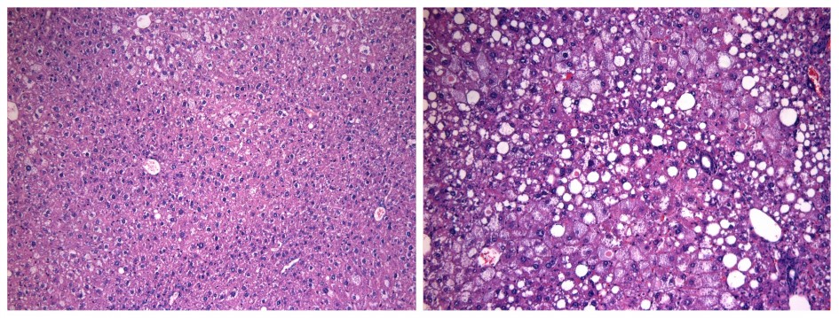 liver-left-normal-right-FBXW7-deletion