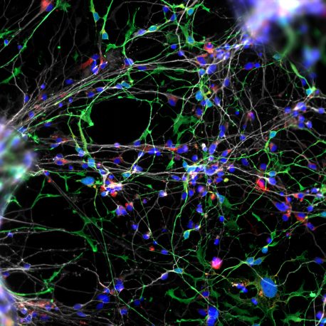 williams-syndrome-neurons-muotri-(1)