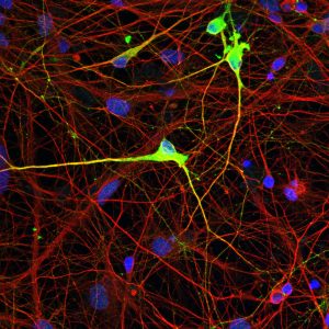 Neurons from Angelman syndrome (AS) patients lack expression of the UBE3A protein due to an epigenetic defect. The new Salk technology restores normal expression of the UBE3A protein in neurons derived from the cells of an AS patient by correcting the aberrant methylation pattern (pictured).