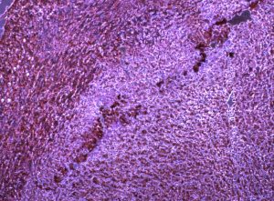 Visible regions of hypoxia in tumor samples correlate with cell signaling linked to suppressing the immune system. 