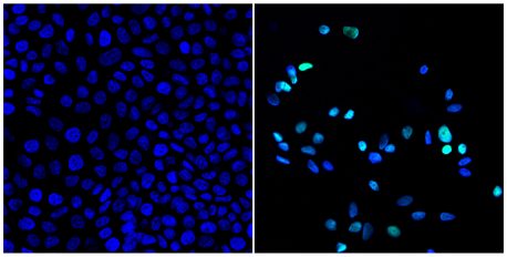 At left, tumor cells shown before treatment with a drug to activate the circadian clock. At right, a greatly reduced number of tumor cells after drug treatment. Green color at right indicates dying cells. 