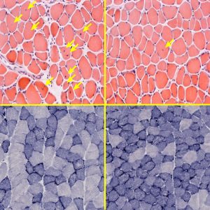 Top left: PGC1 deficiency leads to severe muscle damage, evidenced by numerous centralized nuclei (highlighted with arrows), which is likely due to impaired mitochondrial energy metabolism (bottom left: blue staining shows impaired mitochondrial activity). Such muscle damage and mitochondrial impairment is largely rescued by ERRγ overexpression (top and bottom right).