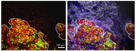 Left panel: Significant numbers of invasive cancer cells with Sox10 (red) in them can be found outside of the tumor (green cells, outlined). Right panel shows the invasive cells’ proximity to blood vessels (white).