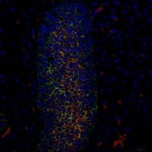 Pictured is mammary tissue at day 18 of a developing mouse embryo, with cells that express both luminal protein (red) and basal protein (green). Cells in breast cancer often show this embryonic characteristic of expressing both proteins.