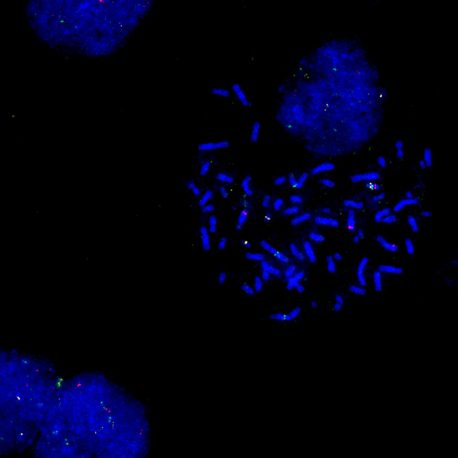 Imagen de microscopía de fluorescencia de ADN (azul) de una célula cancerosa que muestra una variante estructural compleja (el cromosoma se muestra en la parte superior derecha con un grupo de puntos de colores) identificado por el nuevo método de perfilado integrador.