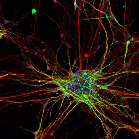 This image shows a two-dimensional culture of subject-derived cortical neurons stained for neuronal markers MAP2 (red) and Tuj1 (green).