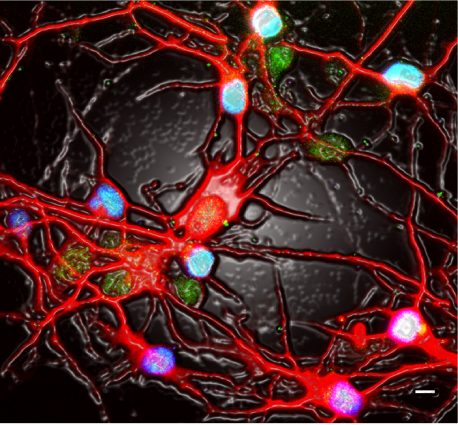  This artistic image shows neurons derived from pluripotent stem cells of antidepressant (SSRI) resistant depressed patients. 