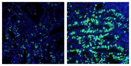 Colon cancer growth, as measured by the number of dividing cells shown in green, is dramatically increased when the FXR-regulated gene network is disrupted by specific bile acids or a high-fat diet.