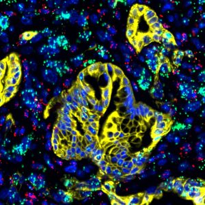 LIF (green), expressed mainly in activated pancreatic stellate cells, is shown along with immune cells (purple) and cancer cells (yellow) in pancreatic cancer tissue.