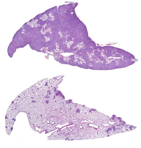 Salk researchers discovered that CREB and its partner, CRTC2, are activated in a subset of non-small-cell lung cancer tumors. The image on the top shows lung tumors (dark purple) in control-group mice compared to those that lack CRTC2 (bottom), which suggests the therapeutic potential for drugs that can interfere with CREB or CRTC2 in this subset of patients.