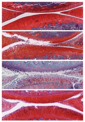 The top image shows a knee joint in a healthy rat. (White indicates cartilage.) The second image from top shows a joint with grade 2 untreated osteoarthritis. The third image shows a joint with osteoarthritis that has worsened from grade 2 to grade 4 after six weeks of placebo therapy. The bottom image shows a joint with osteoarthritis that improved from grade 2 to grade 1 (mild) after six weeks of combination therapy with alphaKlotho and sTGFbR2.