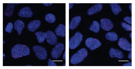 Cells that will eventually become neurons (neural progenitor cells) derived from individuals with autism spectrum disorder, shown in the right panel, exhibit increased DNA damage detected by γH2AX, shown in the red stain, compared to those derived from healthy individuals (left panel).