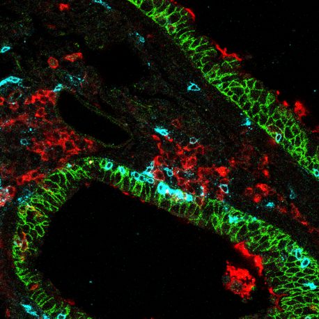 Células T asesinas CD8 específicas de pulmón (azul) en tejido pulmonar (verde) rodeadas de células pulmonares dendríticas (roja).