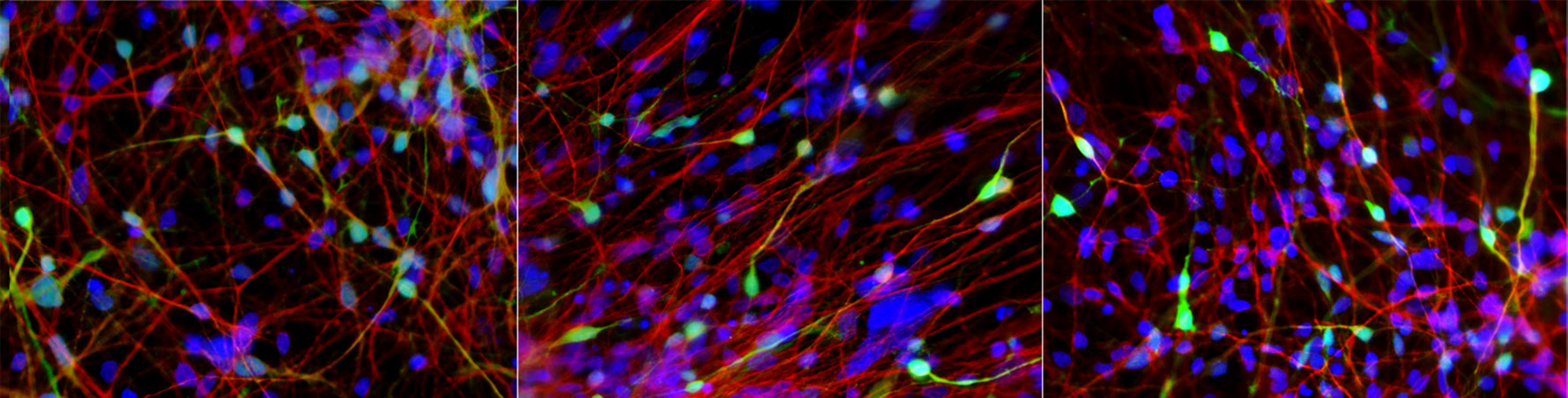 From left: iPSC-derived dentate gyrus (DG)-like neurons (green) from control subject; bipolar lithium responder; and bipolar lithium nonresponder. While the percentage of DG-like neurons is the same for control and bipolar, the gene activation profiles are different and the nonresponder has low levels of Lef1.