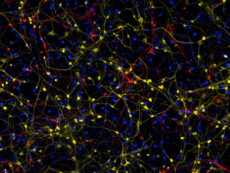This image shows neurons (red) from an individual with Alzheimer’sThis image is a composite of induced neurons (brain cells) from different individuals with Alzheimer’s disease