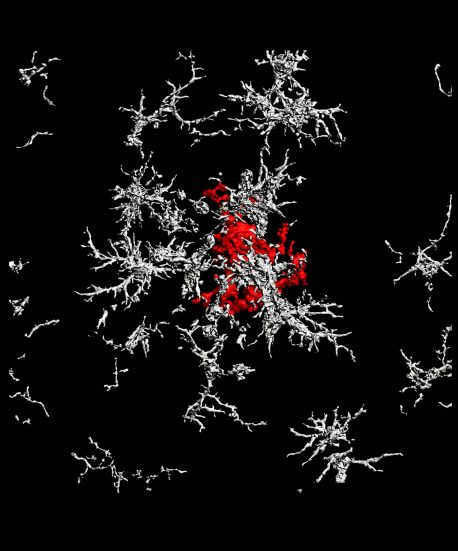 A dense-core amyloid-beta plaque (red) surrounded by microglia that lack TAM receptors (white) in the brain of a mouse with Alzheimer’s disease