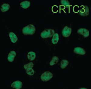 A microscopic view showing that the CRTC3 protein is located in the nucleus of melanoma cells.