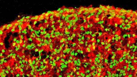 Esta imagen muestra células beta funcionales hechas de células madre pluripotentes humanas. La insulina (roja) y NKX6.1 (verde) indican dos proteínas producidas por las células beta.