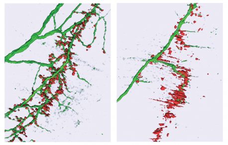 このコンピューター支援再構成は、microRNA-218 (右側) の喪失が神経筋シナプスの破壊を引き起こし、呼吸に必要な筋肉の麻痺を引き起こす様子を示しています。