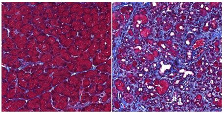 Izquierda: Células acinares (rojas) en un páncreas sano. Derecha: cicatrización pancreática extensa (púrpura) cuando ERR gamma se pierde de las células acinares.