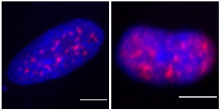 In the central nuclei (blue) of immune cells called macrophages, removing the WASP gene (as in the right panel) leads to fewer clusters of RNA splicing proteins (red).