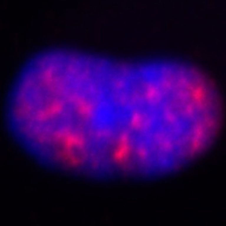 In the central nuclei (blue) of immune cells called macrophages, removing the WASP gene (as in the right panel) leads to fewer clusters of RNA splicing proteins (red).