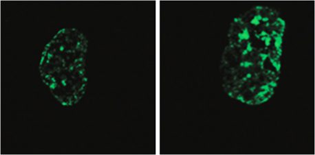 Left: Hutchinson-Gilford progeria syndrome cell with signs of premature aging. This cell shows less histone protein (green), which normally helps maintain the cell’s DNA integrity and function. Right: The cell shows less signs of aging when LINE-1 RNA is reduced, and there is more histone protein present.