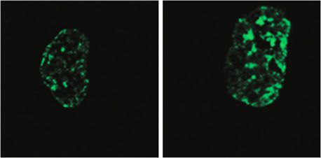 Izquierda: célula del síndrome de progeria de Hutchinson-Gilford con signos de envejecimiento prematuro. Esta célula muestra menos proteína histona (verde), que normalmente ayuda a mantener la integridad y función del ADN de la célula. Derecha: la célula muestra menos signos de envejecimiento cuando se reduce el ARN de LINE-1 y hay más proteína histona presente.