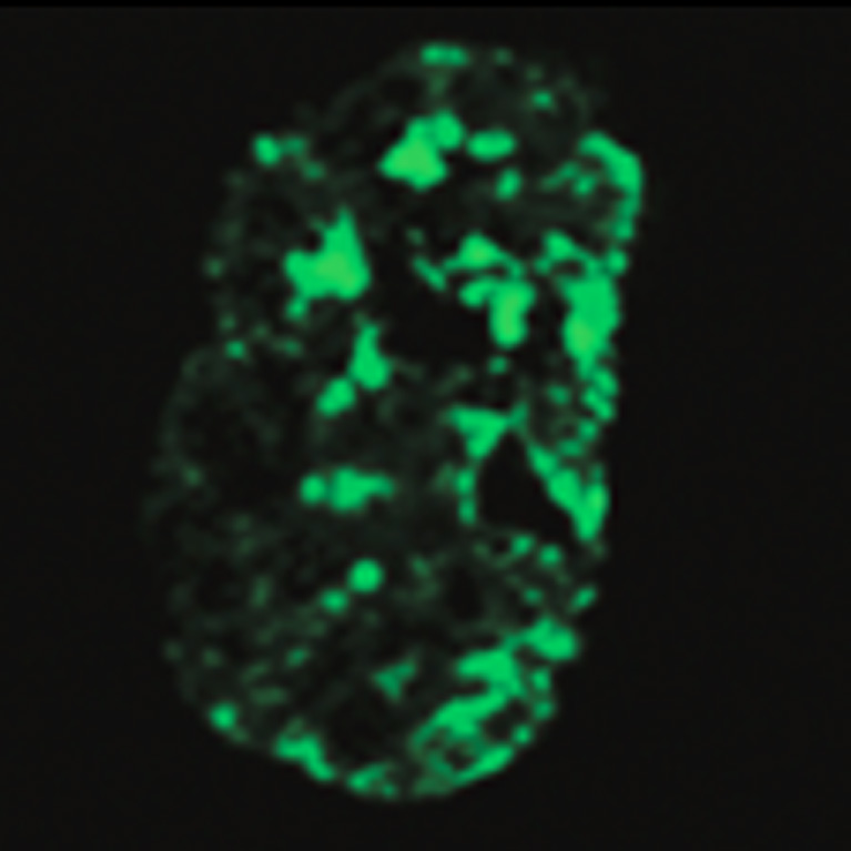 Left: Hutchinson-Gilford progeria syndrome cell with signs of premature aging. This cell shows less histone protein (green), which normally helps maintain the cell’s DNA integrity and function. Right: The cell shows less signs of aging when LINE-1 RNA is reduced, and there is more histone protein present.