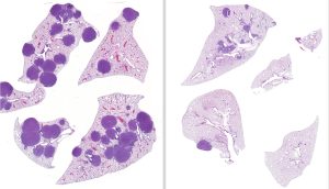 Left: lung tissue of mice with LKB1-mutated non-small cell lung cancer.  Right: Lung tissue showing smaller and fewer tumors after treatment with both trametinib and entinostat. 