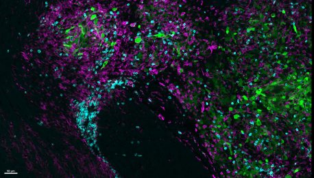 La terapia anti-CTLA-4 induce a las células T asesinas del sistema inmunitario (cian) a infiltrarse en el glioblastoma (verde) y promover una asociación antitumoral con las células inmunitarias residentes en el cerebro llamadas microglía (magenta).