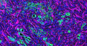 The abundance of cancer-associated fibroblasts (magenta) in the microenvironment with pancreatic cancer cells (green).
