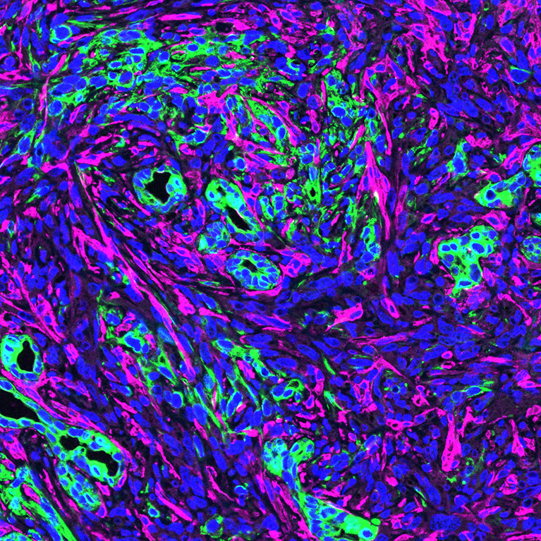 膵臓がん細胞（緑）が存在する微小環境におけるがん関連線維芽細胞（マゼンタ）の多さ。