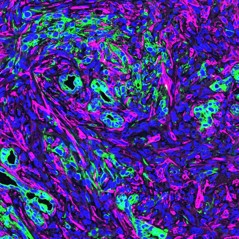 De overvloed aan kankergeassocieerde fibroblasten (magenta) in de micro-omgeving met pancreaskankercellen (groen).