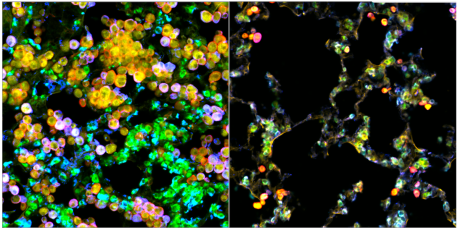 Lung adenocarcinoma tumor cells (green) and macrophages (red) accumulate in the lungs of control mice (left), but expansion of the tumor cells is hindered in macrophage PPARγ knockout mice (right), since the macrophages can’t be metabolically coopted by tumor cells. Cellular cholesterol is visualized in yellow.