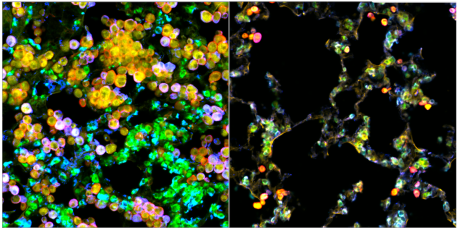 Las células tumorales de adenocarcinoma de pulmón (verde) y los macrófagos (rojo) se acumulan en los pulmones de los ratones de control (izquierda), pero la expansión de las células tumorales se ve obstaculizada en los ratones knockout para macrófagos PPARγ (derecha), ya que los macrófagos no pueden ser cooptados metabólicamente por células tumorales. El colesterol celular se visualiza en amarillo.