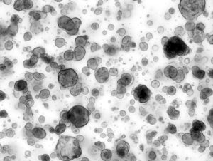 A pancreatic cancer patient-derived organoid line derived at the Salk Institute.