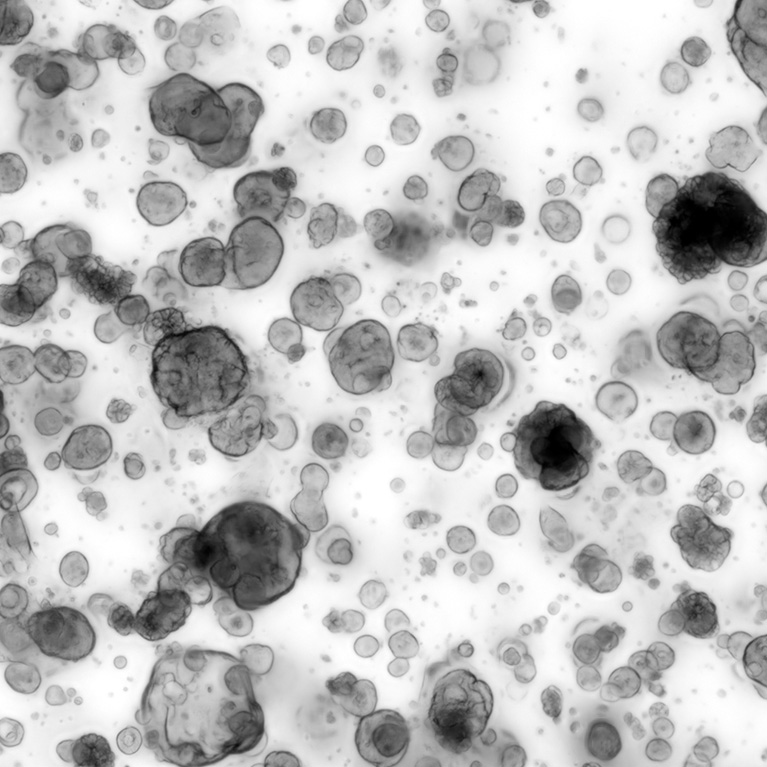 A pancreatic cancer patient-derived organoid line derived at the Salk Institute.