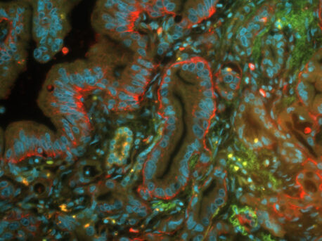 Antithrombin (red) in human pancreatic cells.