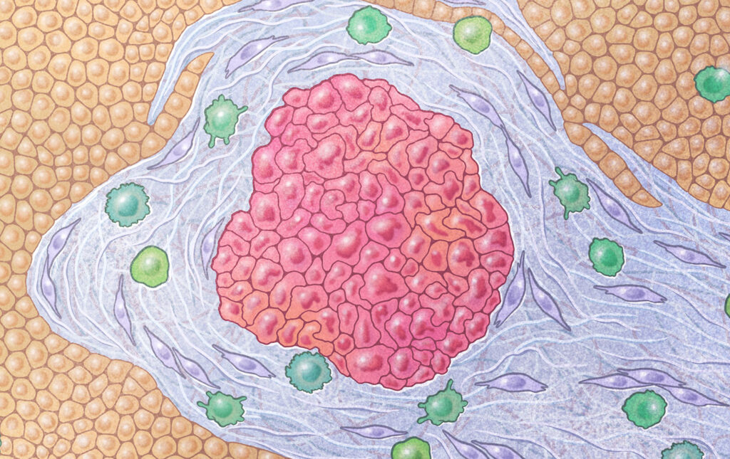 Pancreatic cancer cells (red) are surrounded by a dense fibrotic shield made of activated fibroblasts and connective tissue (purple). Immune cells (green) are prevalent in the tumor microenvironment. Healthy pancreatic cells (orange) are outside of the tumor.