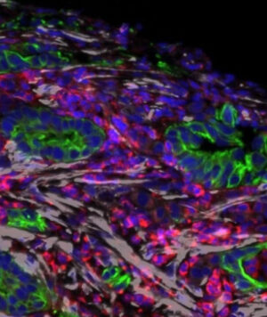 In a metastatic pancreatic tumor, cancer cells (green) are surrounded by activated fibroblasts (grey) that promote therapeutic resistance and create an immunosuppressive microenvironment (red).