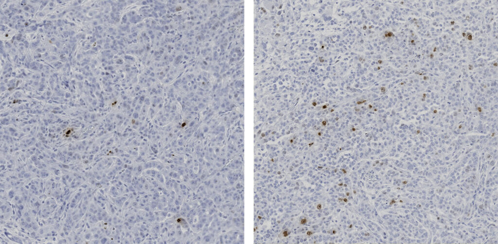 Mouse pancreatic tumors without treatment (left) and after treatment with entinostat bottlebrush nanoparticles (right), which cause elevated DNA damage (brown).