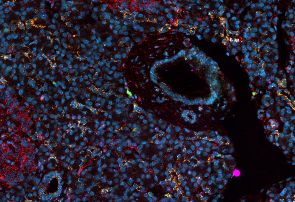 A human pancreas tissue section with markers (red, orange, green, pink) of different chronic pancreatitis subtypes identified by the Salk Institute team.