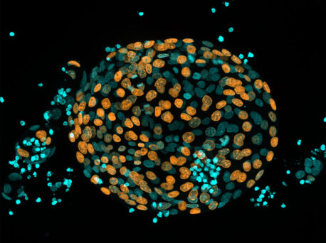 Chronic pancreatitis patient-derived organoids proliferate. Cells actively undergoing cell division are orange while cells not actively dividing are turquoise.