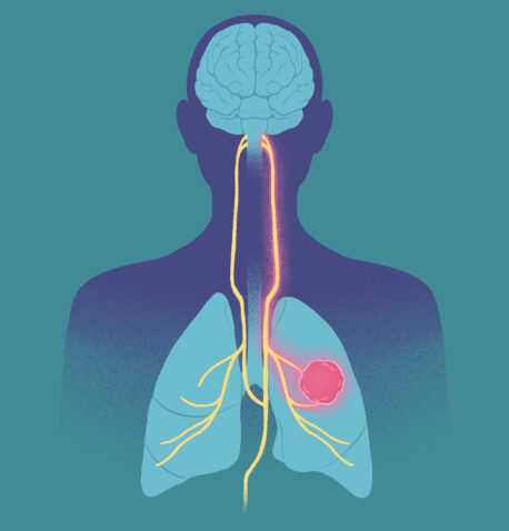 New research from Thales Papagiannakopoulos finds some lung cancer tumors can hijack the nervous system, in turn impacting behavior and exacerbating disease-related wasting.