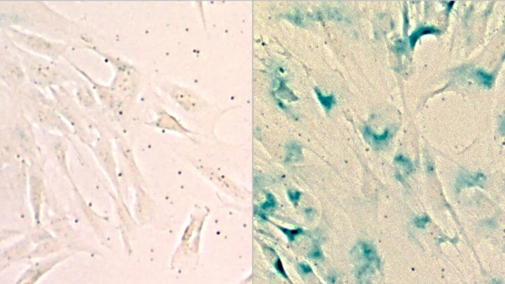 : Healthy lung cells (left) and senescent lung cells (right). Salk Institute researchers found senescent lung cells are more vulnerable to the cell death pathway ferroptosis, contributing to age-related dysfunction.