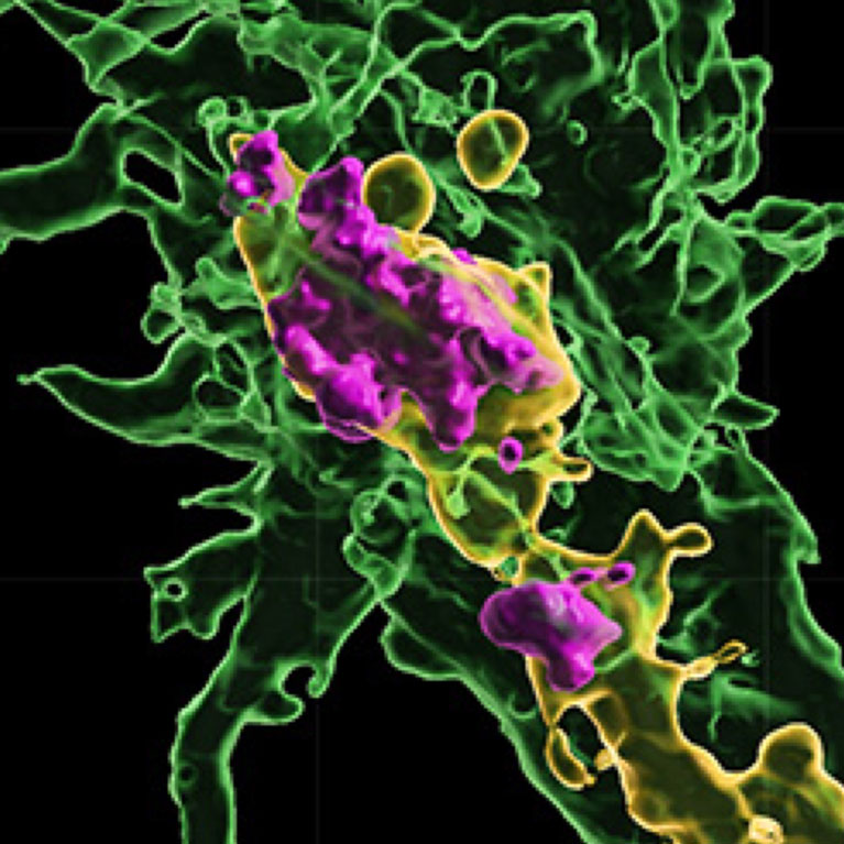 Are predatory brain immune cells eating nerve cells in ALS?