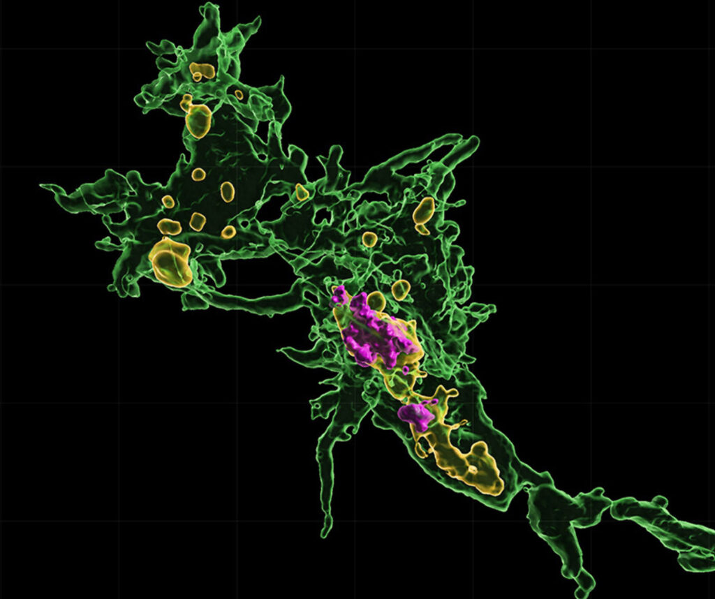 Microglia (green) contain the remnants of motor neurons (purple) inside microglial lysosomes (yellow). Microglia (green) contain the remnants of motor neurons (purple) inside microglial lysosomes (yellow).