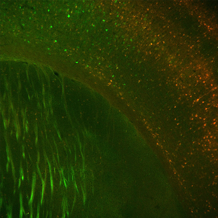 Why does severe illness during pregnancy sometimes harm neurodevelopment?